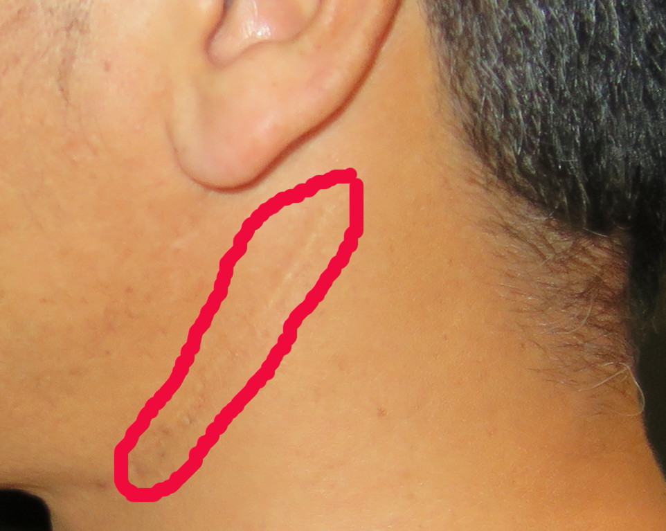 悪性リンパ腫の症状