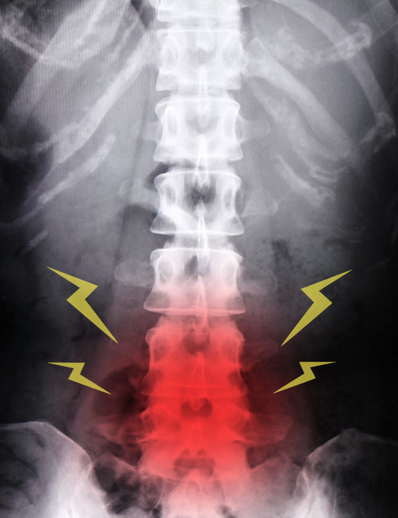腰椎椎間板ヘルニア戦記②坐骨神経痛、腰痛、両肩の痛み