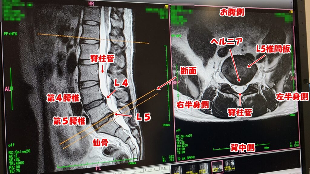 腰椎椎間板ヘルニア戦記2022-② MRIで分かった腰椎症！第５腰椎の骨棘