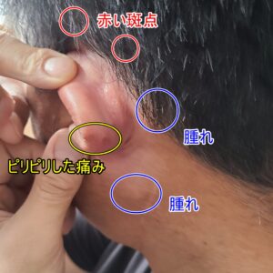 耳輪にピリピリした痛み！耳の周りに赤い斑点とリンパ腫！？これは帯状疱疹！？